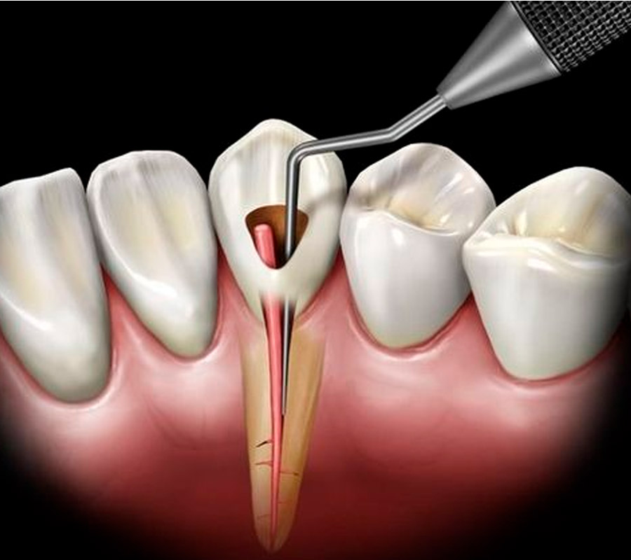 Tratamiento de endodoncia